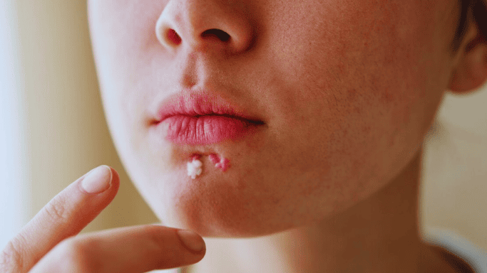 Pimple Lips: How to Spot, Treat, and Avoid Annoying Lip Zits