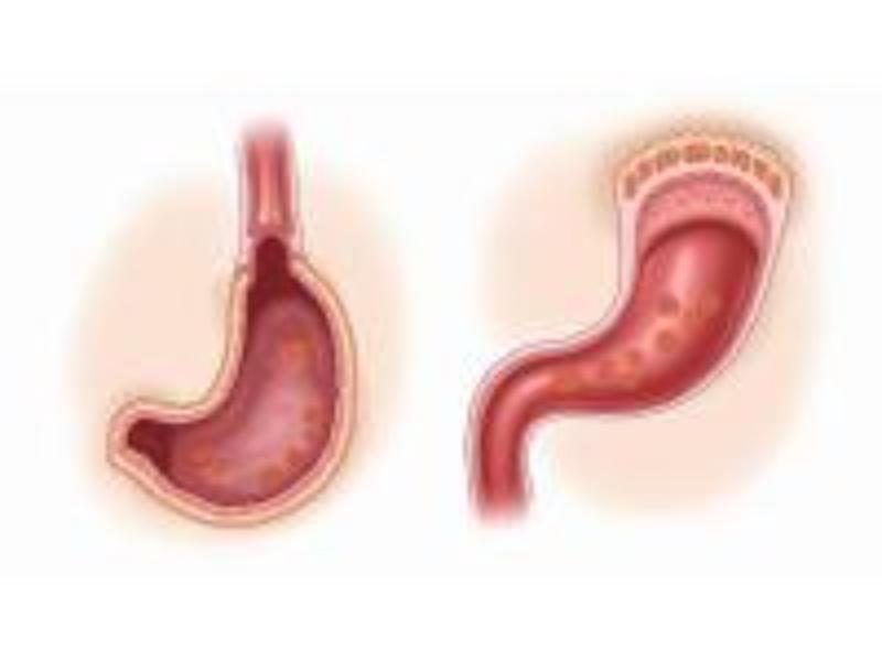 Ulceration Esophagus Explained: How It Affects Your Health